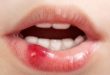 penyebab sariawan di bibir
