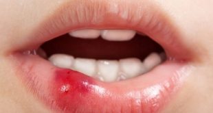penyebab sariawan di bibir